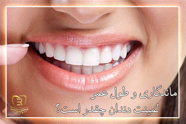 لمینت دندان در چند روز انجام می شود