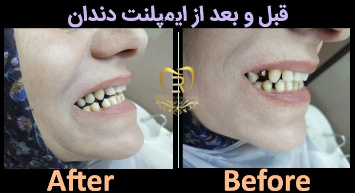 تصویر قبل و بعد از ایمپلنت دندان در رشت
