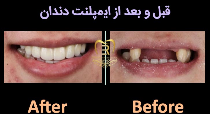 عکس قبل و بعد از ایمپلنت دندان در رشت