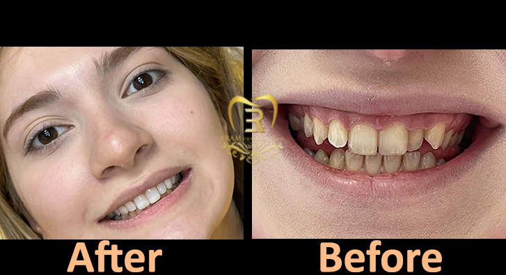 عکس قبل و بعد طراحی لبخند با ونیر کامپوزیت و لیفت لثه