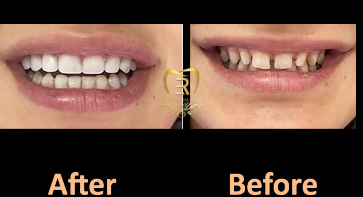 قبل و بعد بیمار با فاصله بین دندان زیاد بدون ارتودنسی با ونیر کامپوزیت