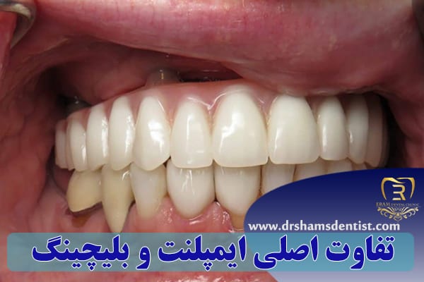 تفاوت ایمپلنت و بلیچینگ دندان