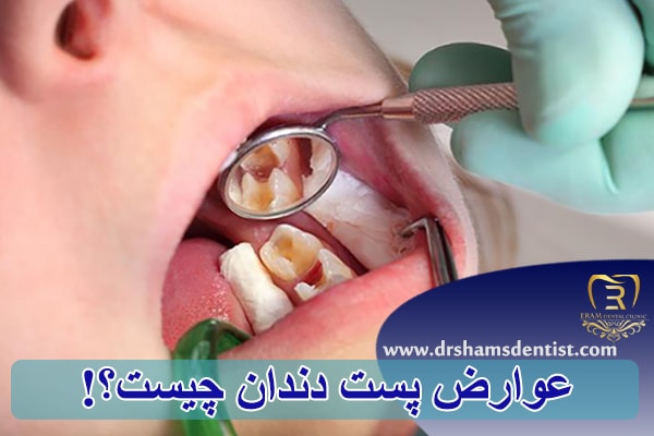 عوارض پست دندان