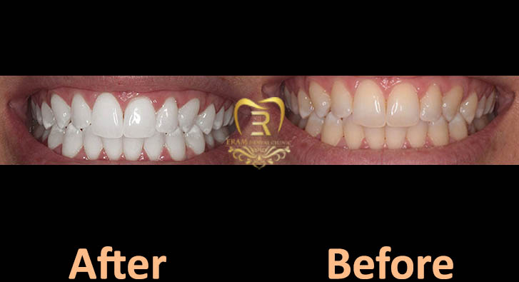 تصوری قبل و بعد بلیچینگ دندان