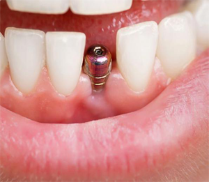 ایمپلنت فوری دندان چیست؟