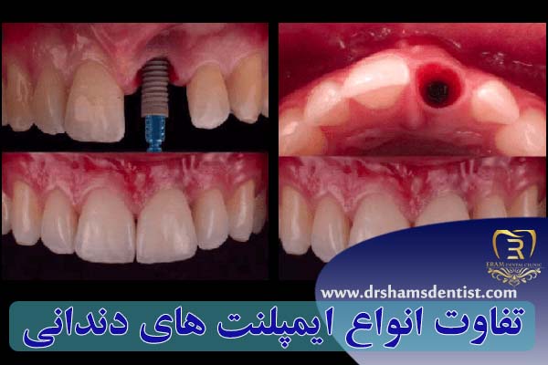 تفاوت انواع ایمپلنت های دندانی