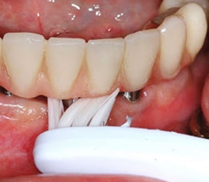 تمیز کردن دندان بعد از ایمپلنت