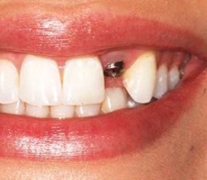 طول عمر ایمپلنت دندان چقدر است؟