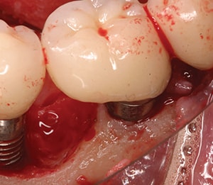 عفونت ایمپلنت‌ دندان
