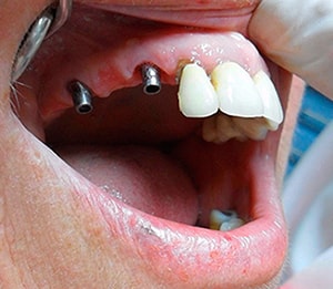 علت پس زدن ایمپلنت دندان چیست؟