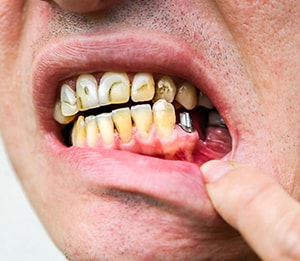آیا دندان ایمپلنت خراب می‌شود؟