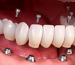 ورم بعد از ایمپلنت دندان طبیعی است؟